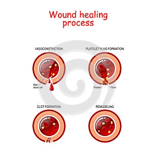 Phases of the wound healing process. poster with capillary, red blood cells, fibrin protein and platelets that healing wound photo