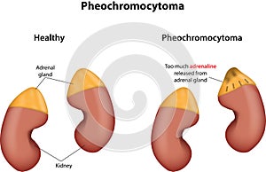 Pheochromocytoma