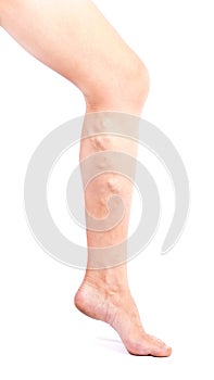 Phlebeurysm disease  on legs on white background. Varicose veins