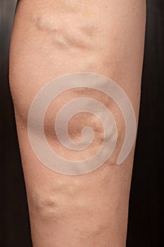 Phlebeurysm, varicose veins of the lower extremities close-up, peripheral vascular disease