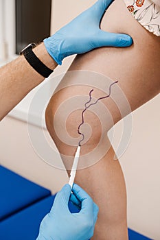 The phlebologist is marking legs before surgery to remove the veins. The vascular surgeon is marking leg veins. Vein