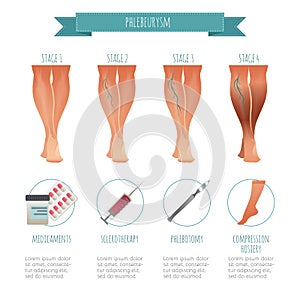 Phlebology infographic, treating varicose veins. Vector illustration of stage of vein diseases. Medical compression