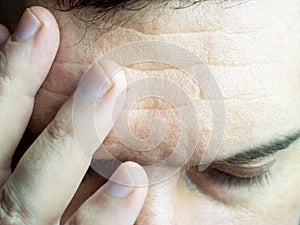 A close-up photo of man pressing his fingers to his forehead, wrinkling his forehead and closing his eyes, showing a