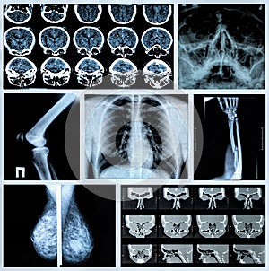 Photo collage: Radiography of Human Bones