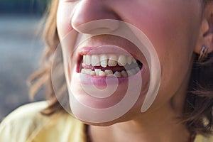 Photo of crooked woman teeth