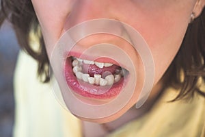 Photo of crooked woman teeth photo
