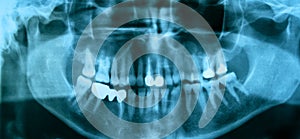 Dental X-Ray. Panoramic x-ray of a mouth