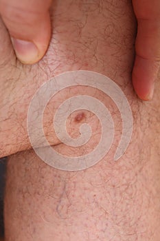 photo of a dermato fibroma on the leg