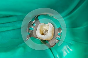 Photo endodontic treatment of dental canals in the lower molar p