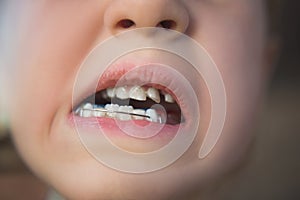 Photo of a little girl`s mouth with an orthodontic appliance and crooked teeth