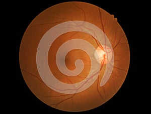 Photo medical detailing retina and optic nerve