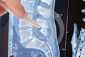 Photo MRI lumbosacral spine pathology. Radiologist indicated on possible pathology or disease of image of spine lumbosacral MRI su photo