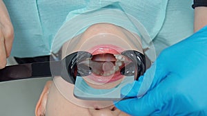 Photo of the patient's jaw using retractors and a mirror.