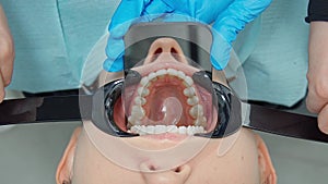 Photo of the patient's jaw using retractors and a mirror.