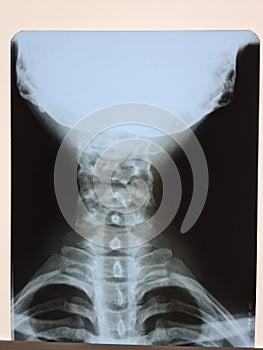 Photo of x-ray image of human neck