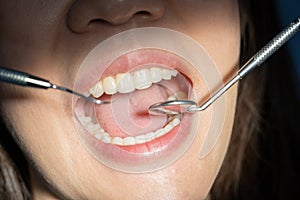 Photo of smiling woman mouth under treatment at the dental clinic: Healthy lifestyle, healthcare, medicine, and teeth health