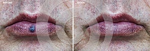 Photo before and after treatment for venous lake on the lower lip of mouth.