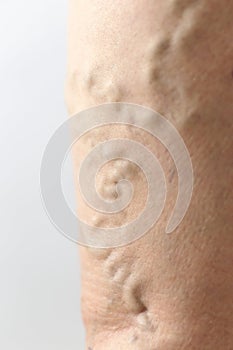 Photo of varicose veins on a female legs