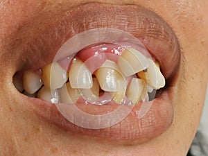 Photo of woman mouth with the upper and lower opposing teeth do not align or Malocclusion. photo