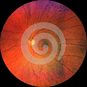 Photograph of the Fundus Oculi