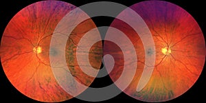 Photograph of the Fundus Oculi