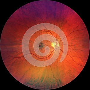 Photograph of the Fundus Oculi