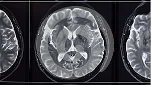 Photograph of T2 weighted magnetic resonance imaging of normal brain