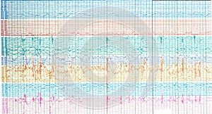 Photography of brain waves  of epileptic patient showing sharp wave during  no seizure or interictal EEG