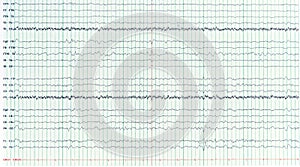 Photography of sharp wave during interictal EEG in epilepsy