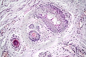 Basal cell carcinoma, light micrograph photo
