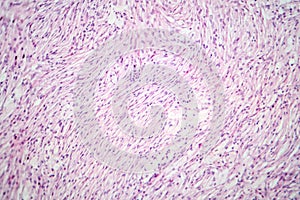 Photomicrograph of a giant cell tumor of bone, revealing its cellular structure under the microscope