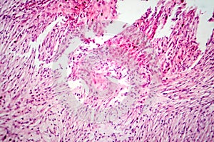 Photomicrograph of a giant cell tumor of bone, revealing its cellular structure under the microscope