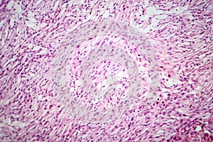 Photomicrograph of a giant cell tumor of bone, revealing its cellular structure under the microscope