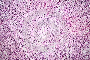 Photomicrograph of a giant cell tumor of bone, revealing its cellular structure under the microscope