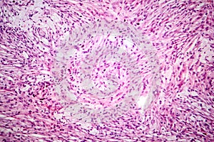 Photomicrograph of a giant cell tumor of bone, revealing its cellular structure under the microscope