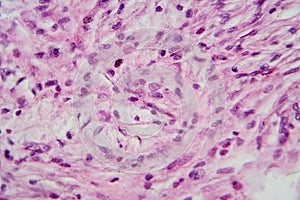 Photomicrograph of a giant cell tumor of bone, revealing its cellular structure under the microscope