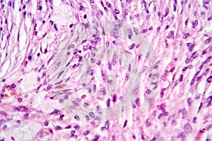 Photomicrograph of a giant cell tumor of bone, revealing its cellular structure under the microscope