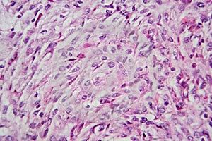 Photomicrograph of a giant cell tumor of bone, revealing its cellular structure under the microscope