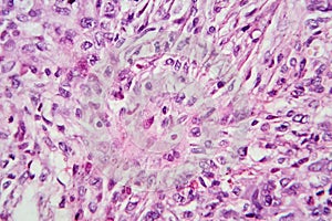 Photomicrograph of a giant cell tumor of bone, revealing its cellular structure under the microscope