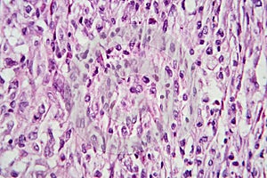 Photomicrograph of a giant cell tumor of bone, revealing its cellular structure under the microscope