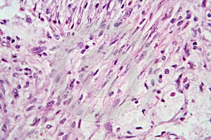 Photomicrograph of a giant cell tumor of bone, revealing its cellular structure under the microscope