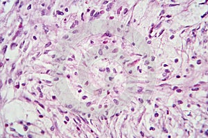 Photomicrograph of a giant cell tumor of bone, revealing its cellular structure under the microscope