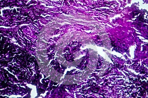 Photomicrograph of lung tissue with silicosis pathology under a microscope, revealing silica particle accumulation in alveoli and