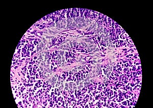 Photomicrograph of stained slide of Histology. A Slide of malignancy. Biopsy. histopathology photo