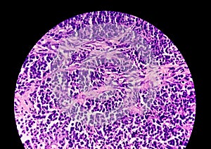 Photomicrograph of stained slide of Histology. A Slide of malignancy. Biopsy. histopathology