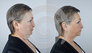 Second chin lift in senior woman. Photos before and after plastic surgery, mentoplasty or facebuilding. Chin fat removal and face photo