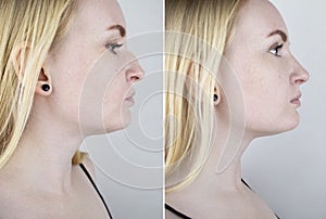 Photos before and after plastic surgery to correct the nasal septum. A woman who has had rhinoplasty or septoplasty