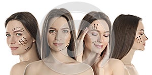 Photos of woman with lifting marks on face against white background, collage. Cosmetic surgery