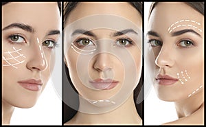 Photos of young woman with lifting marks on face against background, collage. Cosmetic surgery