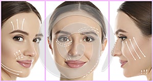 Photos of young woman with lifting marks on face against white background. Cosmetic surgery